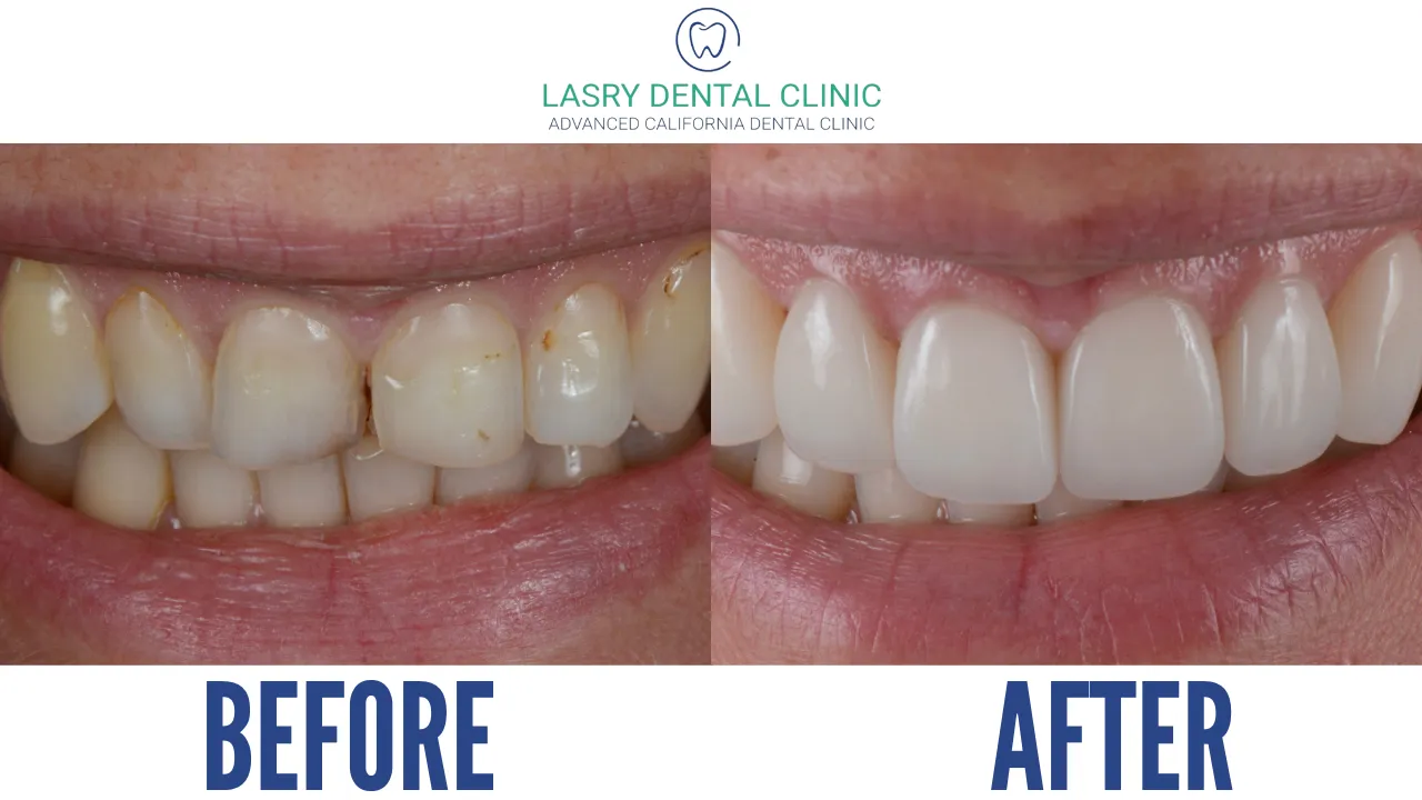 24483 post whitening care