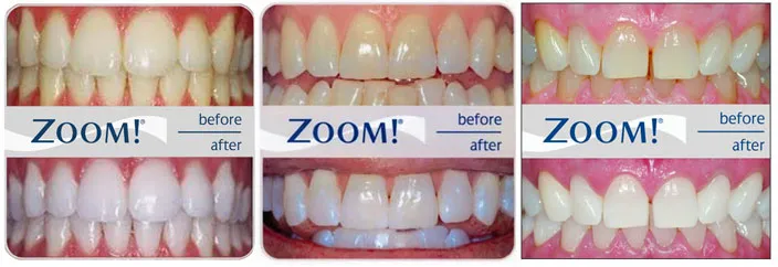 24483 zoom whitening sensitivity intro