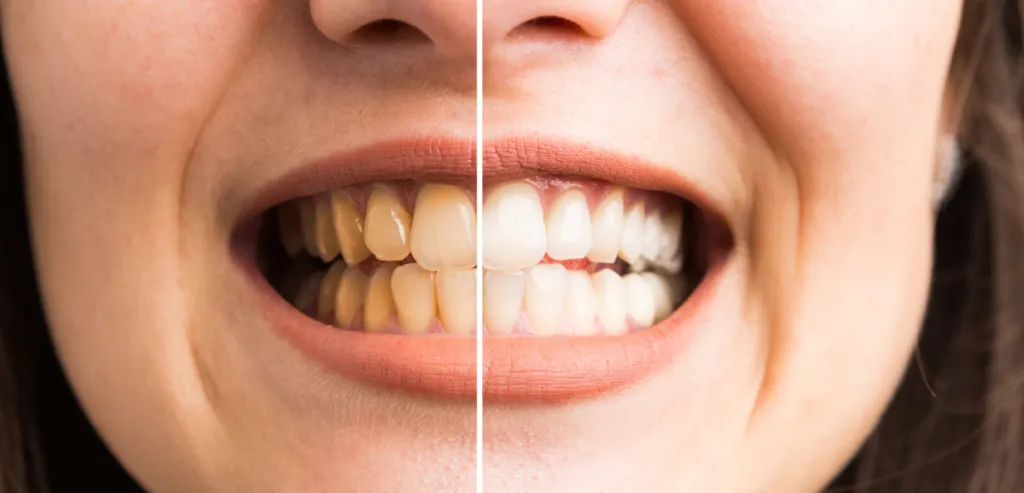 24614 whitening effectiveness