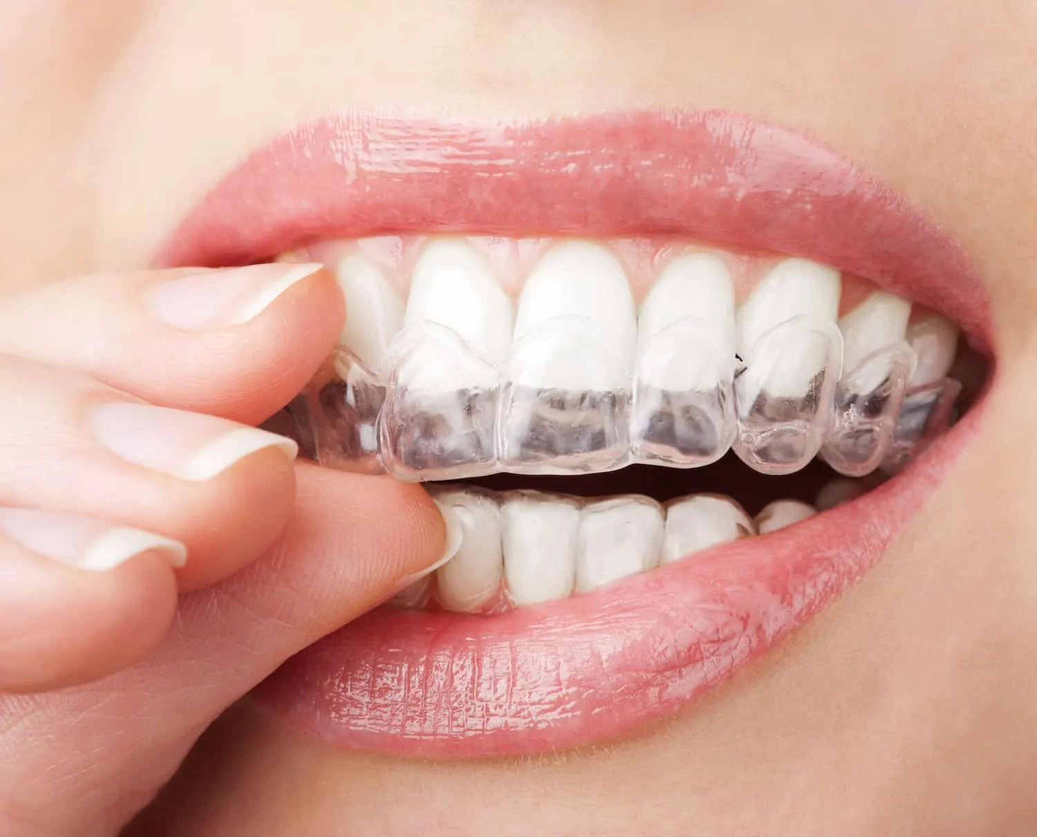 24623 gingival irritation