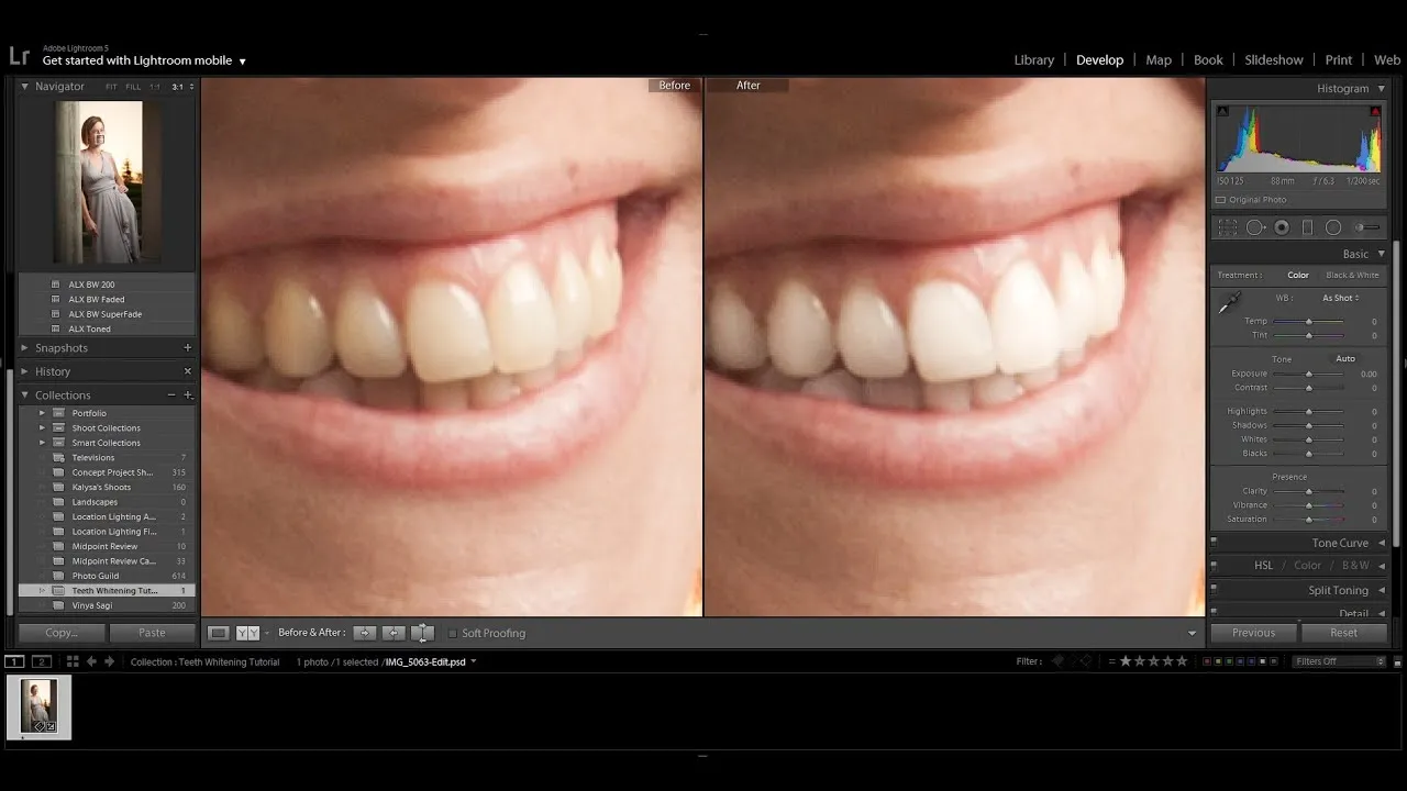 24639 teeth before after