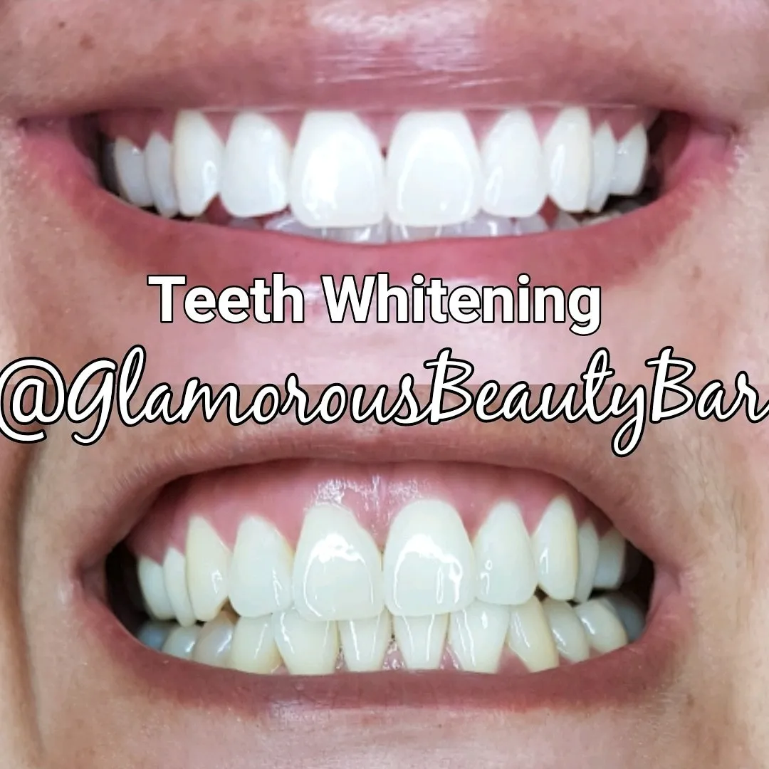 24682 flash white teeth whitening before after