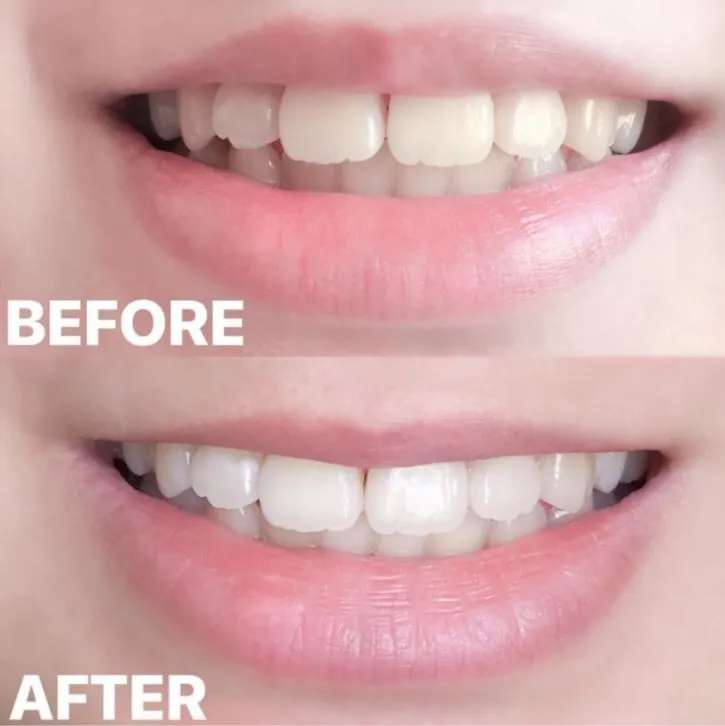 24682 teeth whitening science