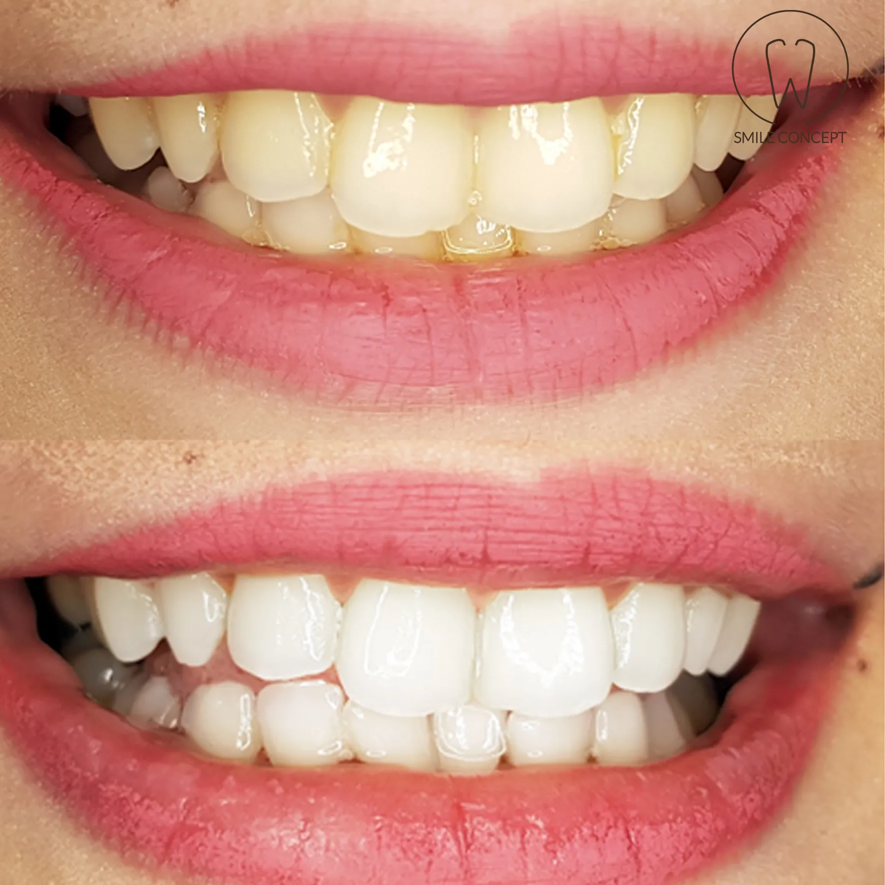 24682 teeth whitening sensitivity